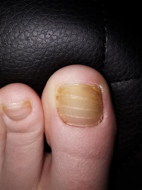 double layer toenail